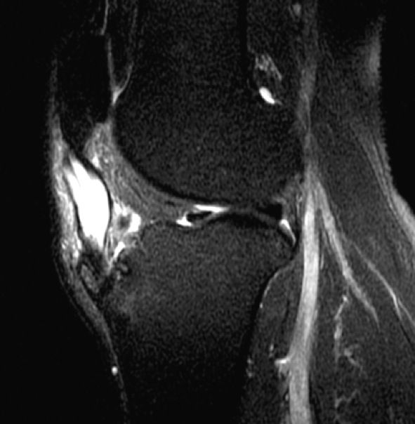 Figure 3 for case Intratenindous ganglion